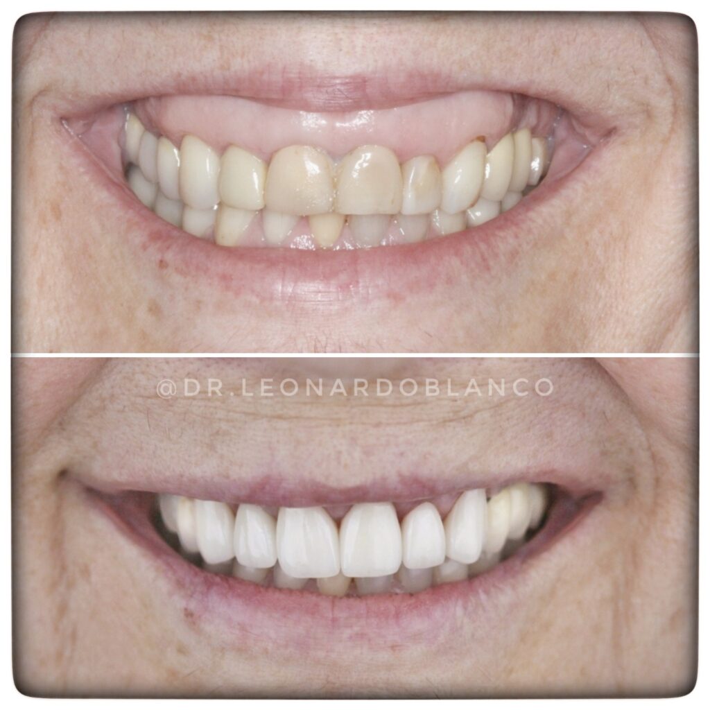 LENTES E GENGIVOPLASTIA